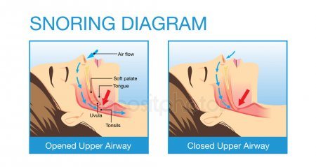 Snoring Diagram