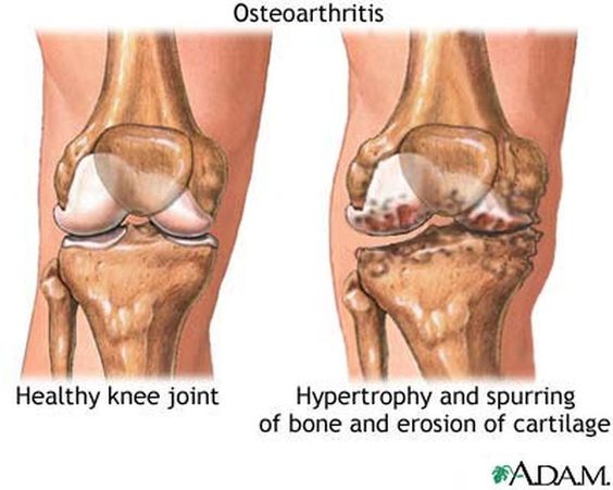 Osteoarthritus 