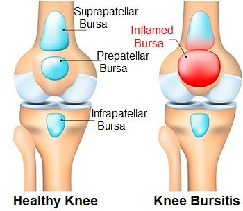 Bursitis