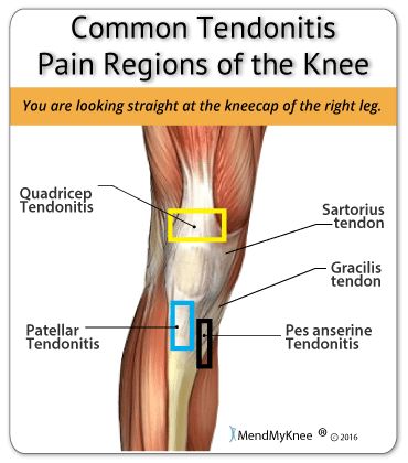 Knee Pain - Tendonitis 