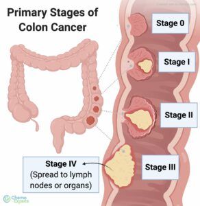 Facts on Colon Cancer - Treatment for Colon Cancer