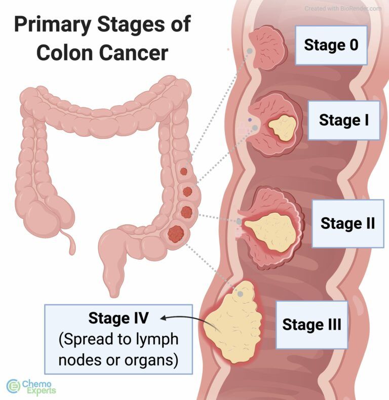 Facts on Colon Cancer Universal Health Products