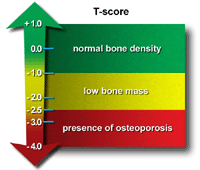 Osteoporosis: The Facts - Diagnosis