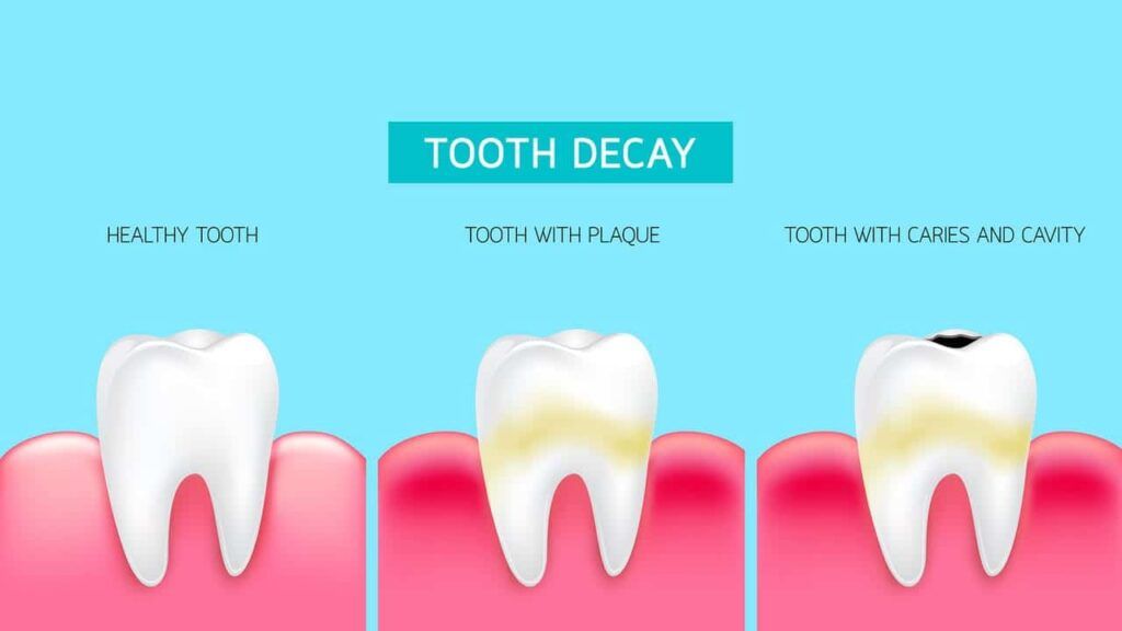 All about Dental Care - Tooth Decay