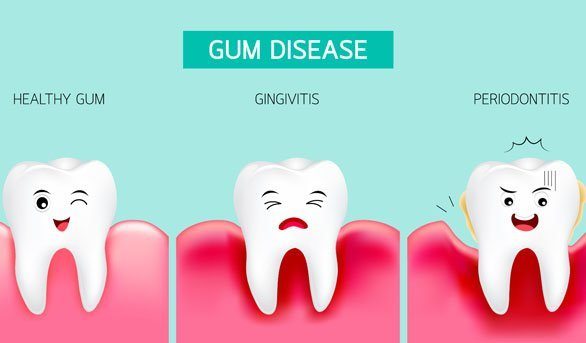 All about Dental Care - gum disease