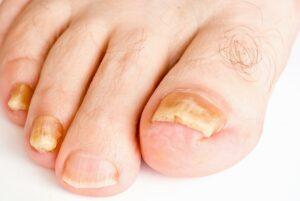 The Toenail Fungus - Toenail Fungus Complications