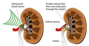 All about Kidney Stones - Treatment 2