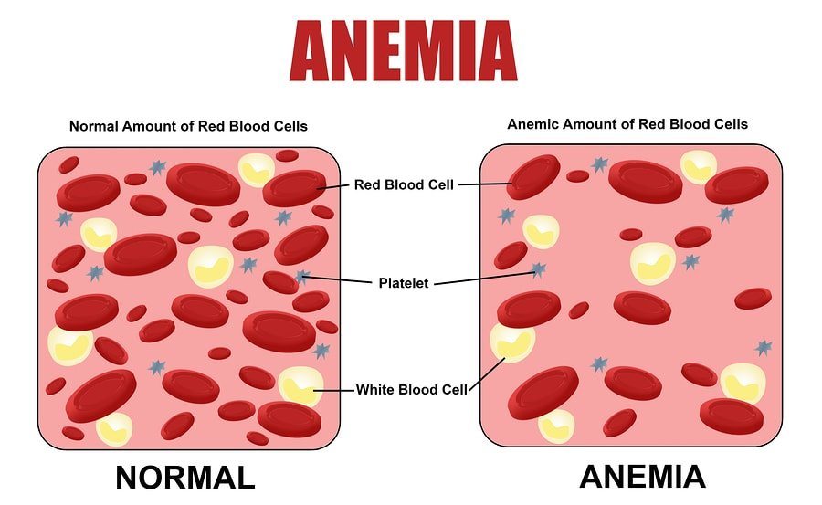 Iron: The Facts - Iron Anemia